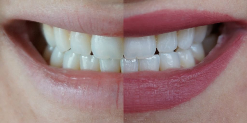 Smile Brilliant Teeth Whitening Testimonial | Madison Fichtl | Madison-fichtl.com
