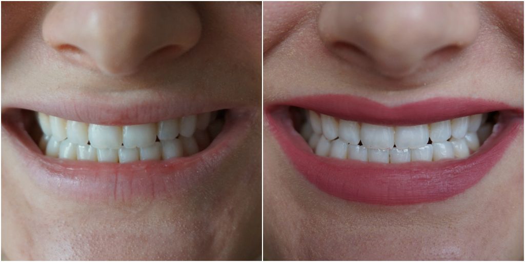 Smile Brilliant Teeth Whitening Testimonial | Madison Fichtl | Madison-fichtl.com