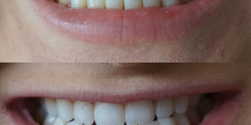 Smile Brilliant Teeth Whitening Testimonial | Madison Fichtl | Madison-fichtl.com