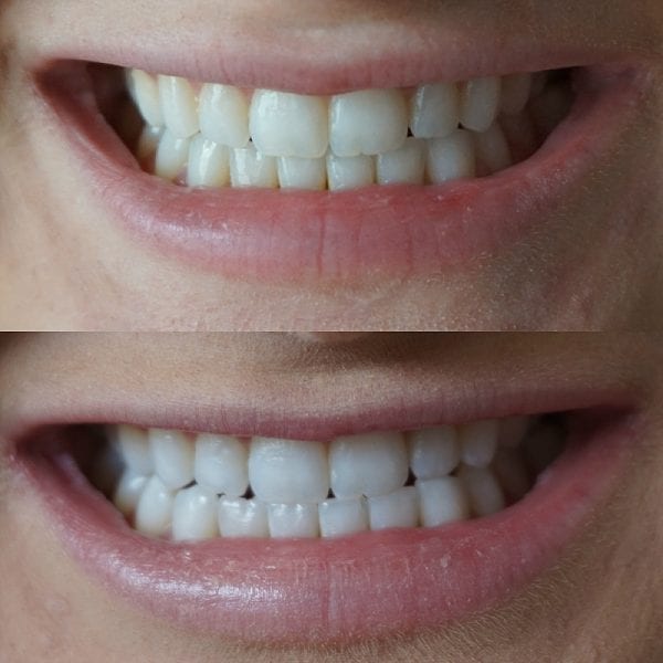 5 Things to Check Before Choosing a Dental Plan