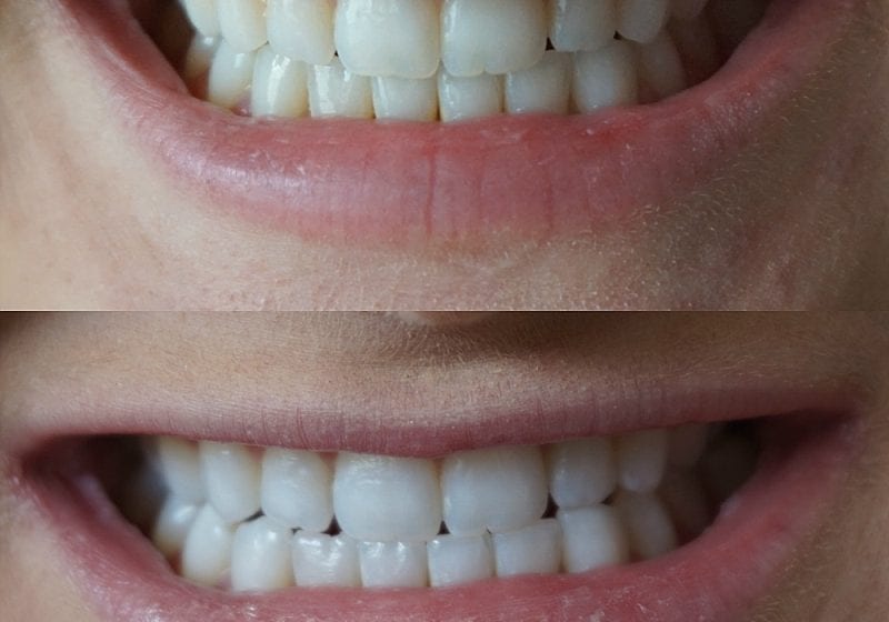Smile Brilliant Teeth Whitening Testimonial | Madison Fichtl | Madison-fichtl.com